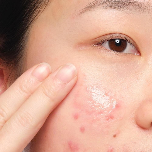 Best Cleanser for Acne-Prone Skin: Your Ultimate Guide to a Clearer Complexion